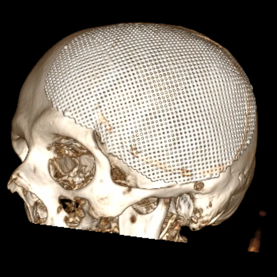 Skull defect: scan after surgery