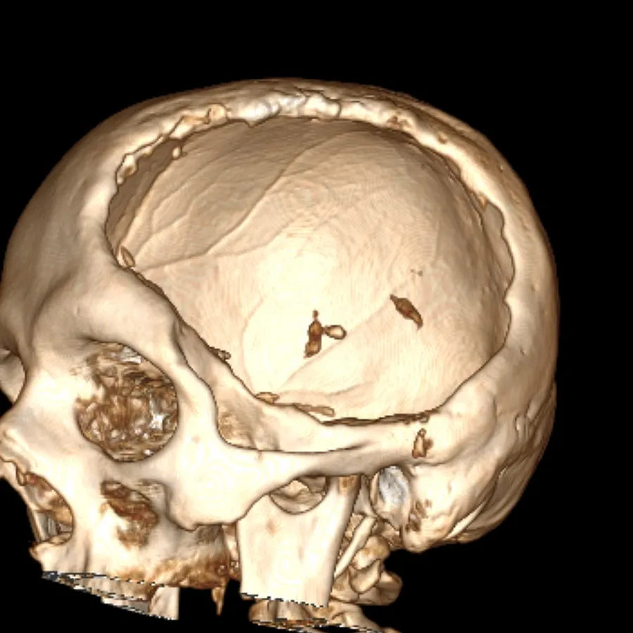 Skull defect: scan before surgery